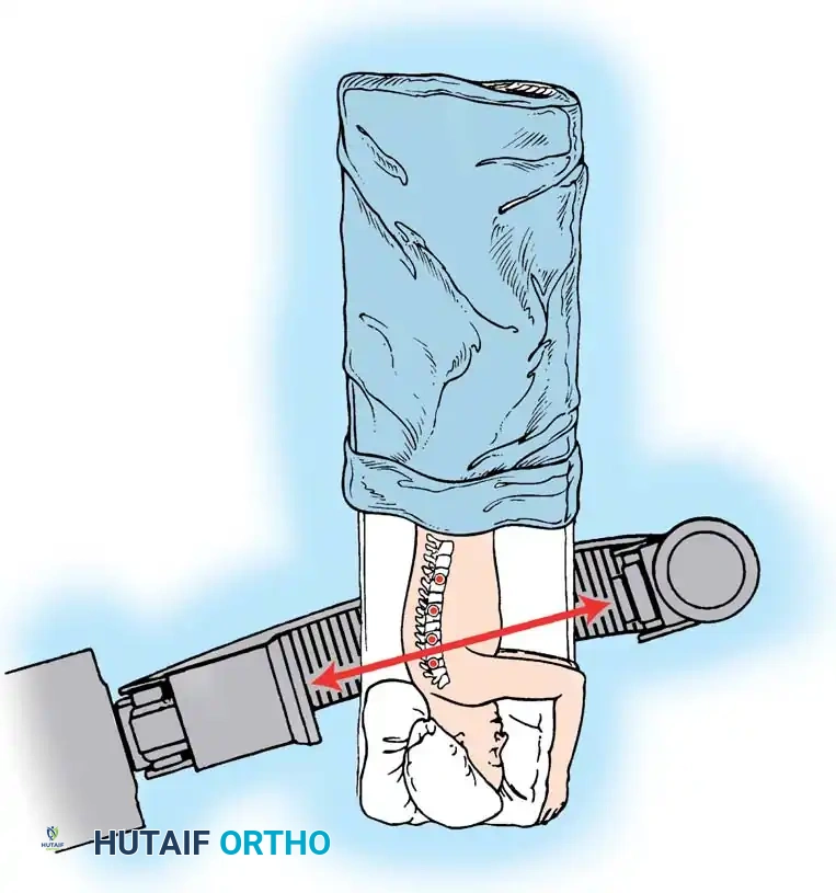 Endoscopic Anterior Instrumentation of Idiopathic Scoliosis: A Master Surgical Guide
