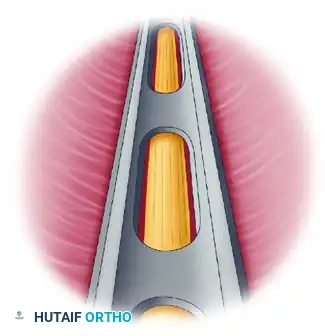 Incision and Superficial Dissection