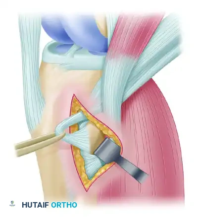 ENDOSCOPIC QUADRUPLE HAMSTRING GRAFT Surgical Diagram