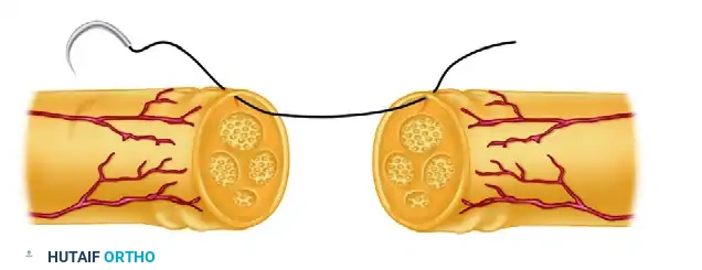 Epineurial Neurorrhaphy: A Comprehensive Microsurgical Guide