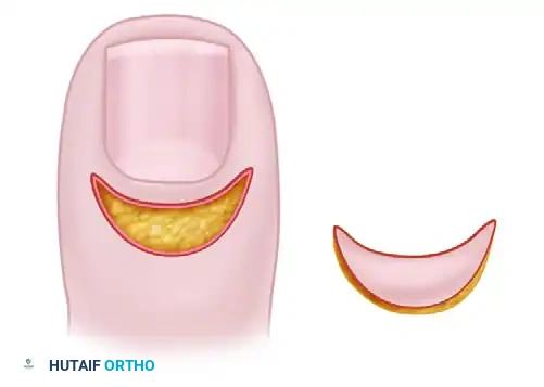 تقنية اللفافة السويسرية لعلاج التهاب ما حول الظفر مع الحفاظ على صفيحة الظفر