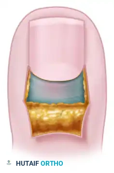 رسم توضيحي يوضح تقنية توخيف طية الظفر لعلاج الداحس المزمن