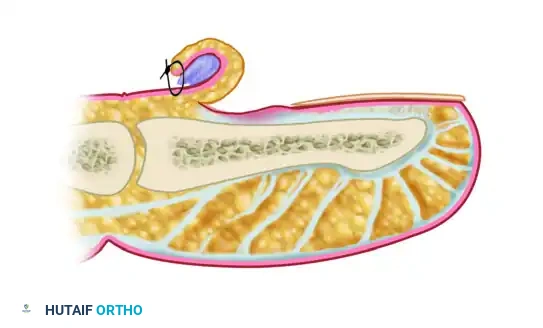 مخطط جراحي يوضح خطوات عملية توخيف طية الظفر