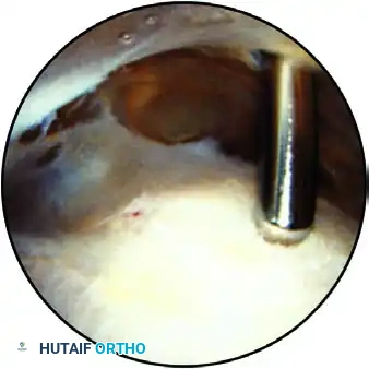 ESTABLISHING THE SUPERIOR PORTAL Surgical Diagram
