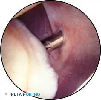 ESTABLISHING THE SUPERIOR PORTAL Surgical Diagram