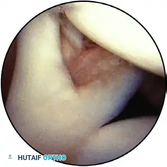 ESTABLISHING THE SUPERIOR PORTAL Surgical Diagram