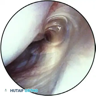 ESTABLISHING THE SUPERIOR PORTAL Surgical Diagram
