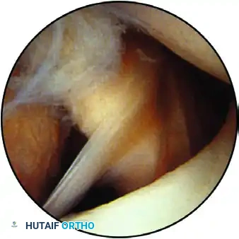 ESTABLISHING THE SUPERIOR PORTAL Surgical Diagram