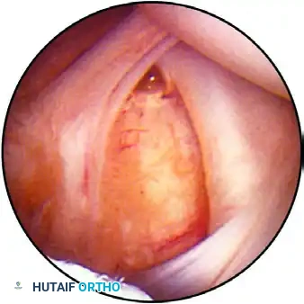 ESTABLISHING THE SUPERIOR PORTAL Surgical Diagram
