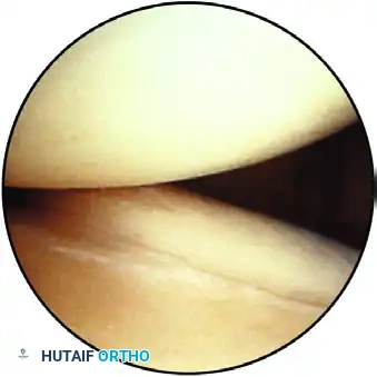 ESTABLISHING THE SUPERIOR PORTAL Surgical Diagram