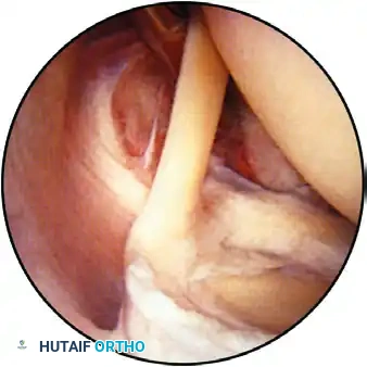ESTABLISHING THE SUPERIOR PORTAL Surgical Diagram