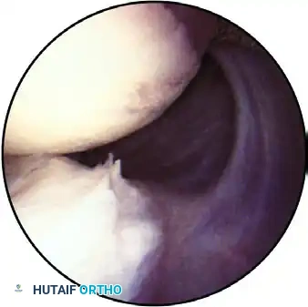 ESTABLISHING THE SUPERIOR PORTAL Surgical Diagram