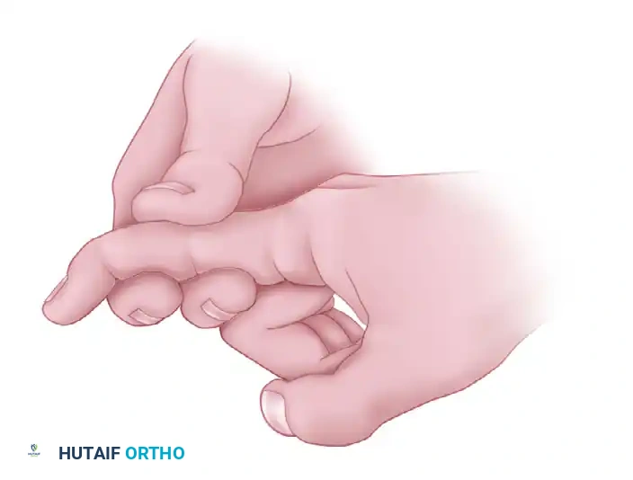 FIGURE 66-4 If proximal interphalangeal joint can be actively flexed while adjacent fingers are held completely extended, sublimis tendon has not been severed.