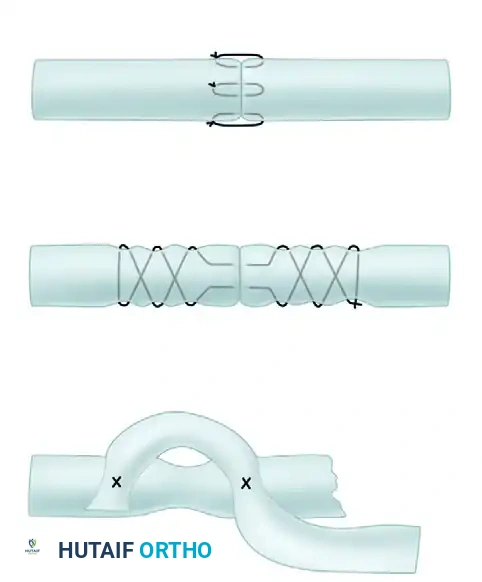 Group 1 Anastomosis Variant