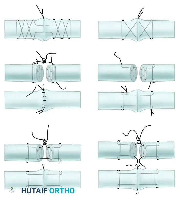 Common Core Sutures