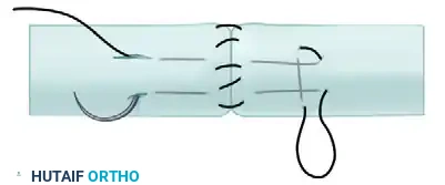 Advanced Suture Configuration