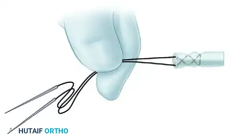 Advanced Suture Configuration