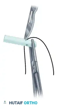 الدليل الشامل لعلاج إصابات الأوتار القابضة في اليد وجراحتها