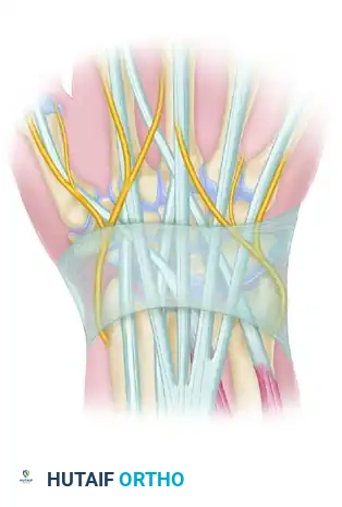 EXCISION OF A DORSAL WRIST GANGLION Surgical Diagram