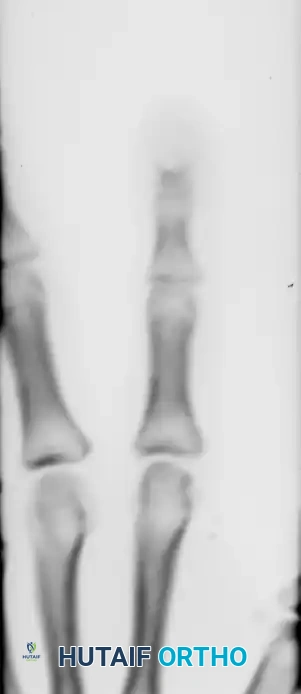 Excision of Wrist Ganglia and Hand Cysts: Surgical Guide