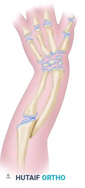 Operative Management of Congenital Hand and Forearm Anomalies