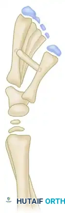 Filleted Skin Flap Closure