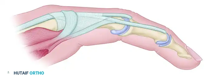 Extensor aponeurosis anatomy