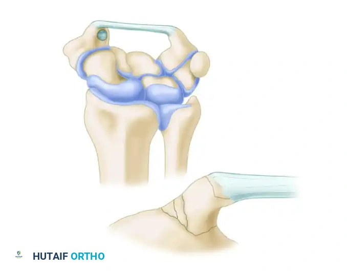 Flexor carpi radialis