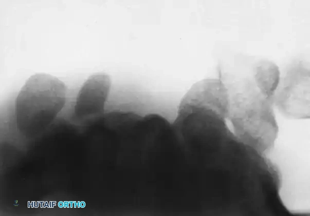 EXCISION OR REDUCTION AND FIXATION OF THE HOOK OF THE HAMATE Surgical Diagram