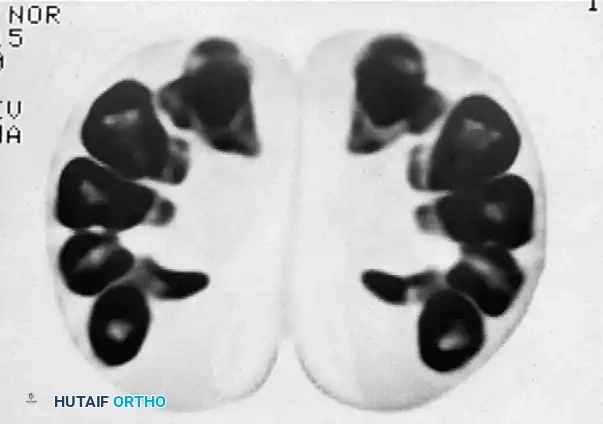 Operative Management of Hamate, Trapezium, and Rare Carpal Fractures