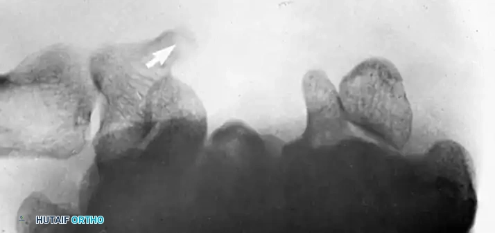 EXCISION OR REDUCTION AND FIXATION OF THE HOOK OF THE HAMATE Surgical Diagram