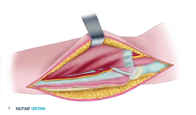 EXTENSIVE RELEASE OF THE FLEXOR PRONATOR ORIGIN Surgical Diagram