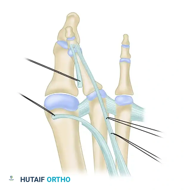 EXTENSOR DIGITORUM BREVIS TRANSFER FOR CROSSOVER TOE DEFORMITY Surgical Diagram