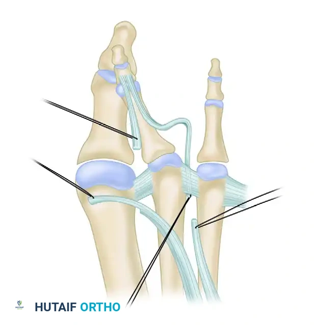 EXTENSOR DIGITORUM BREVIS TRANSFER FOR CROSSOVER TOE DEFORMITY Surgical Diagram