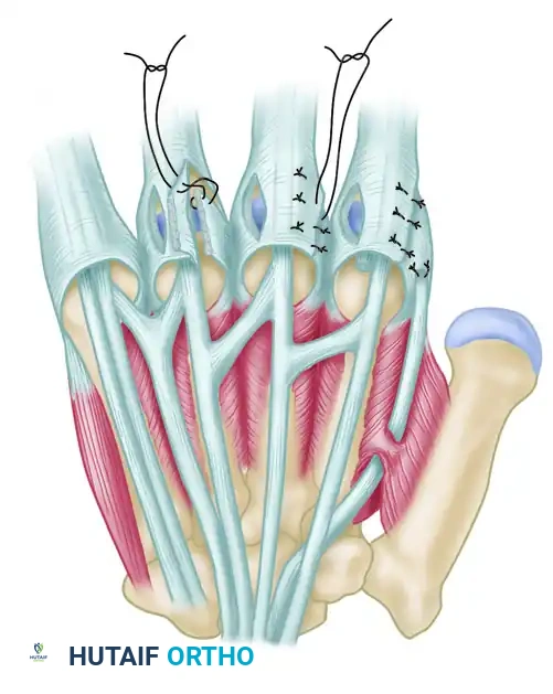 Extensor Tendon Realignment and Intrinsic Rebalancing in the Rheumatoid Hand