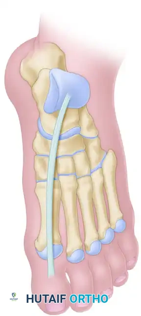 Tendon Routing and Fixation