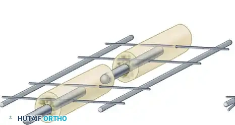 EXTERNAL FIXATION Surgical Diagram