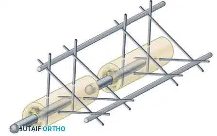 EXTERNAL FIXATION Surgical Diagram