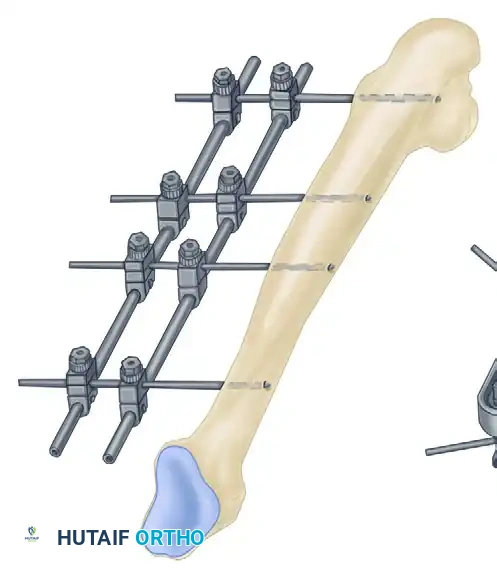EXTERNAL FIXATION Surgical Diagram