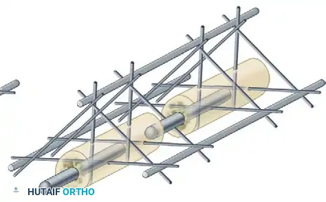 EXTERNAL FIXATION Surgical Diagram