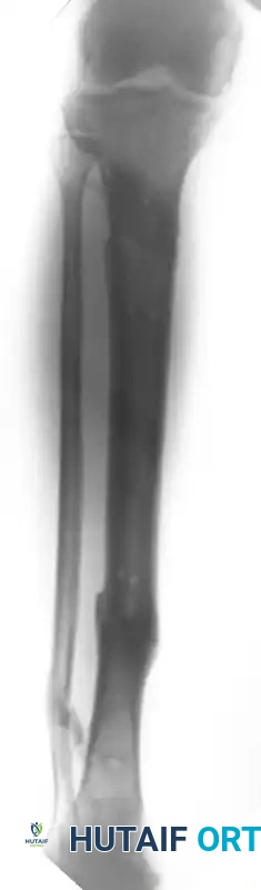 EXTERNAL FIXATION Surgical Diagram