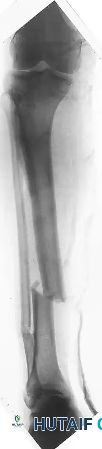 EXTERNAL FIXATION Surgical Diagram