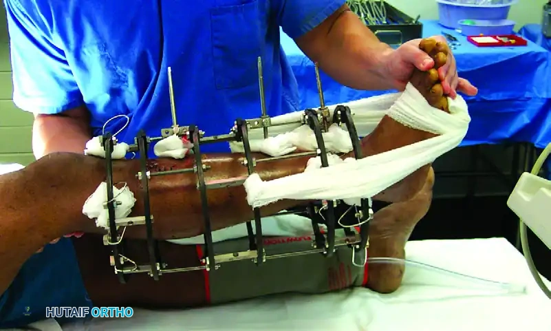 EXTERNAL FIXATION Surgical Diagram