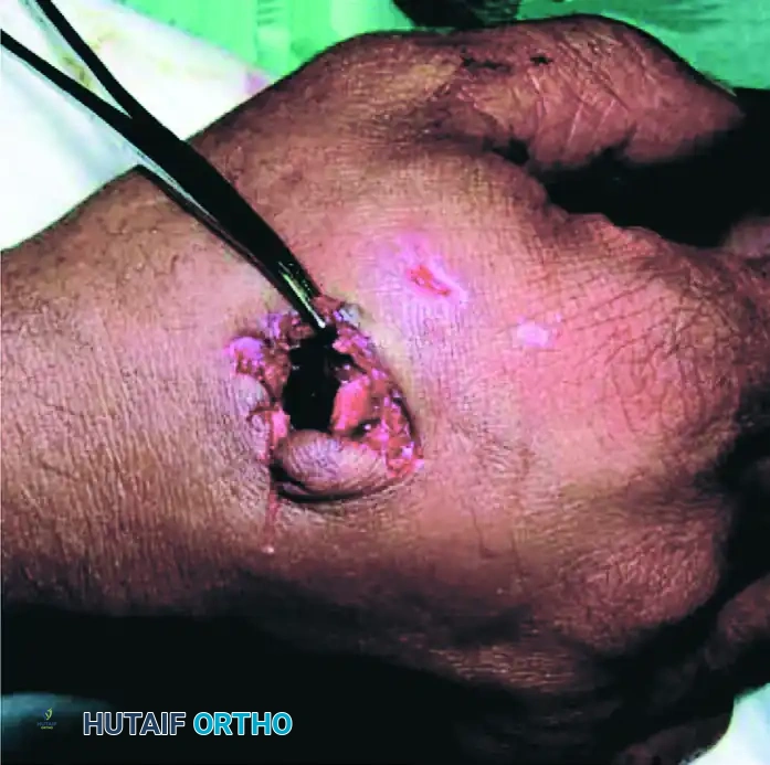EXTRAVASATION INJURIES Surgical Diagram