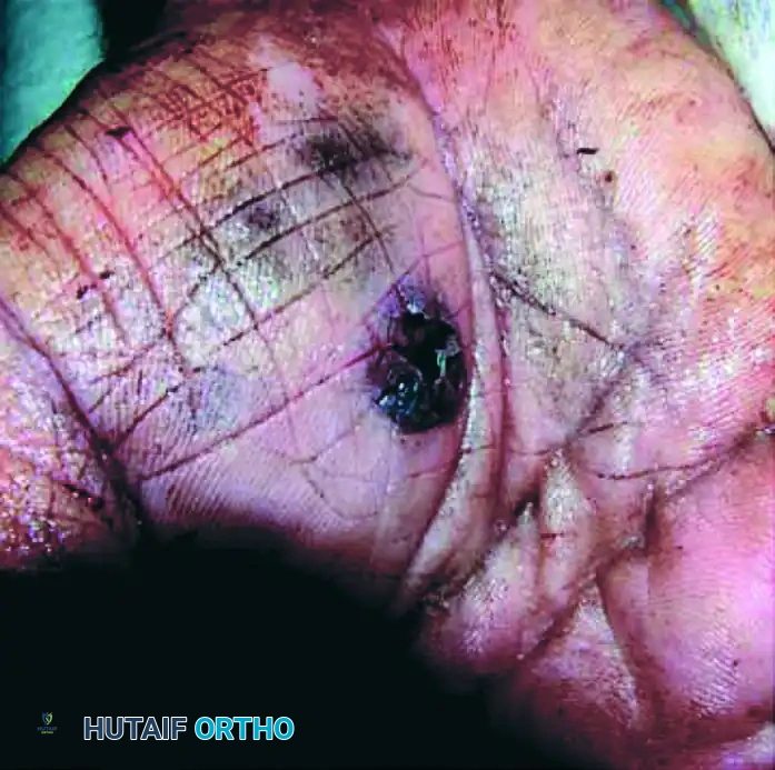 EXTRAVASATION INJURIES Surgical Diagram