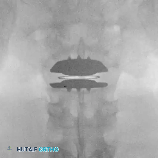 Fig. 39-47 B, Lateral view of patient with internal disc derangement treated with Charité total disc replacement.