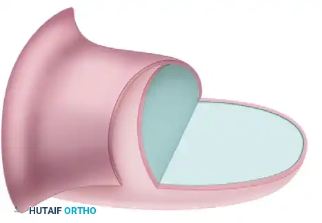 Transverse Deficiencies: Arrest of Development & Surgical Management