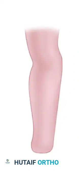 FAILURE OF FORMATION (ARREST OF DEVELOPMENT) Surgical Diagram