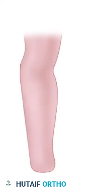 FAILURE OF FORMATION (ARREST OF DEVELOPMENT) Surgical Diagram