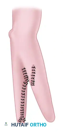 FAILURE OF FORMATION (ARREST OF DEVELOPMENT) Surgical Diagram